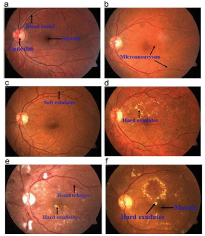 Six fundus images annotated with the retinal features associated with diabetic retinopathy