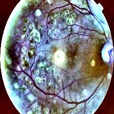 Fundus image with CLAHE and Gaussian filtering with color